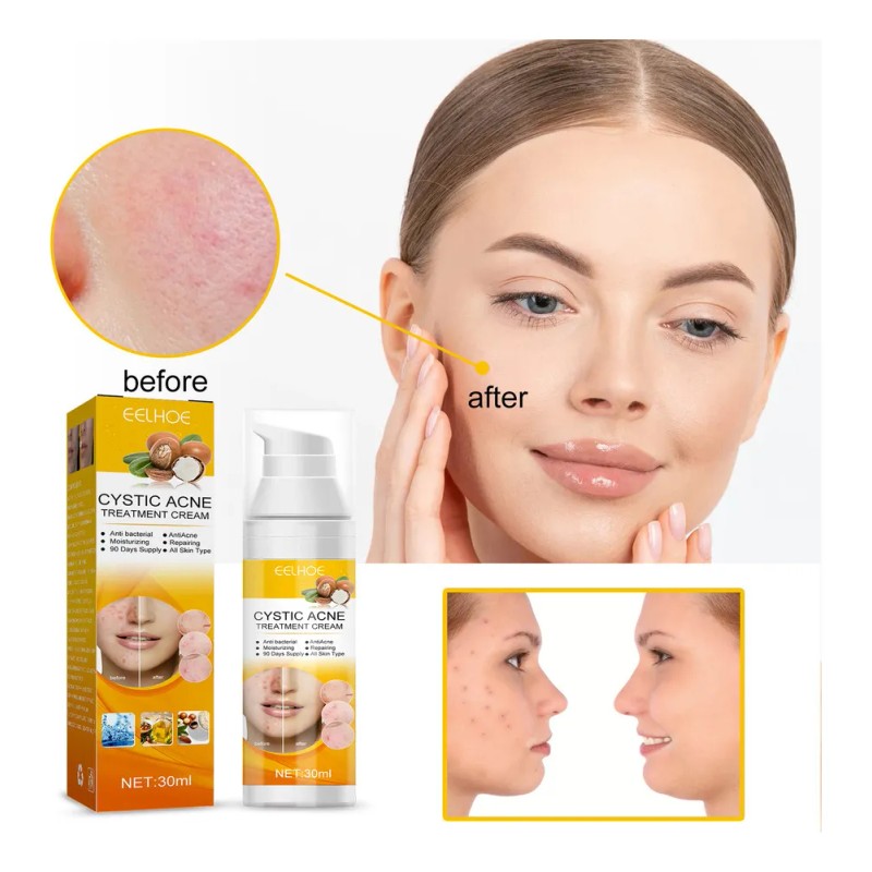 3×crema Para Tratar El Acné: Combate Acné Hormonal Quístico