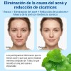 Acne Buster Loción Secante Con Ácido Salicílico 10ml Todo Tipo