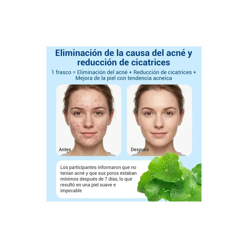 Acne Buster Loción Secante Con Ácido Salicílico 10ml Todo Tipo