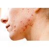 skinclean acne limpieza granos, neotrex./ 20 ml g