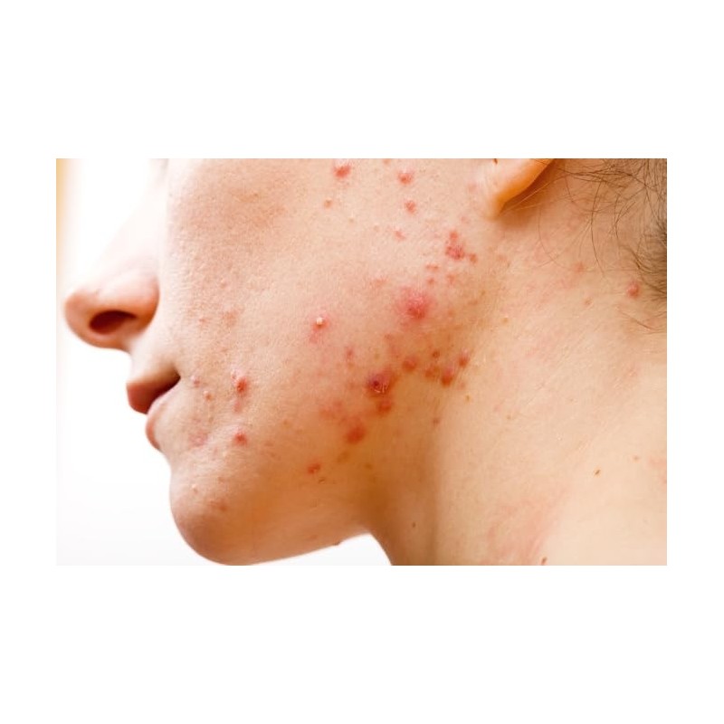 skinclean acne limpieza granos, neotrex./ 20 ml g