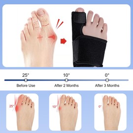 Zonoori 1 Pair Hallux Valgus Correction, Hallux Valgus Splint, 2 Correction Splint and 2 x Toe Separators