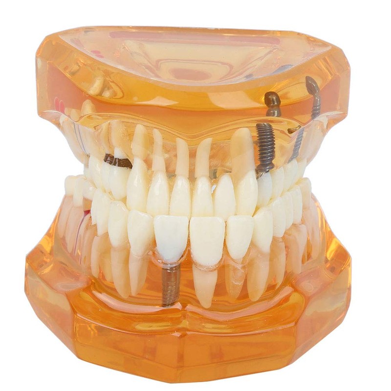 Dental Model Dental Disease Teaching Model Removable Implant Teeth Model