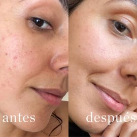 Sérum facial antiacné y antimanchas para piel grasa con acido glicolico y vitamina C 30 ml. Biotiks