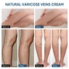 TANGDIAABBCC Varicose Veins Treatment for Legs, Varicose Veins Treatment Cream,