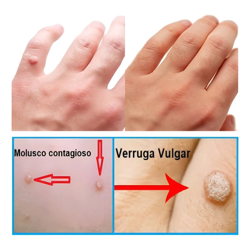 Elimina Mezquinos Granos Lunares Verrugas Manchas Vph