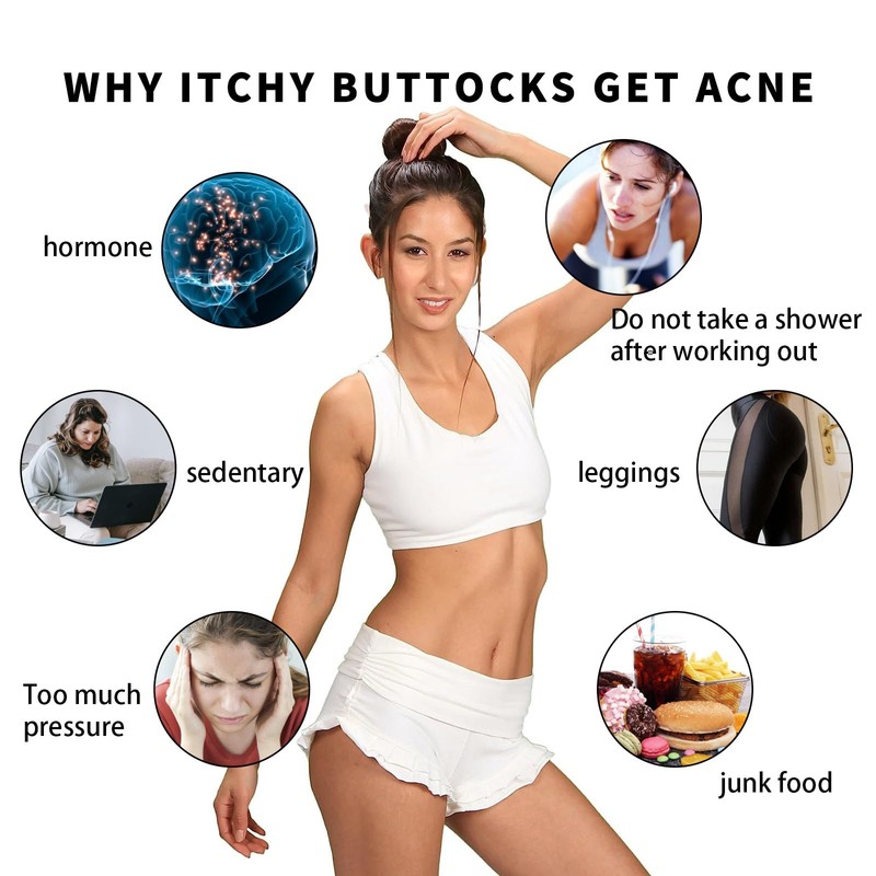 KOAHDE The Butt And Thigh Area,Butt Pimple Removing Cream,Reduce Acne