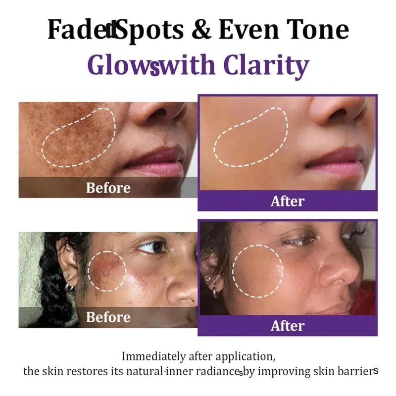 Crema Epiglow Melanex Antihiperpigmentante Avanzada,