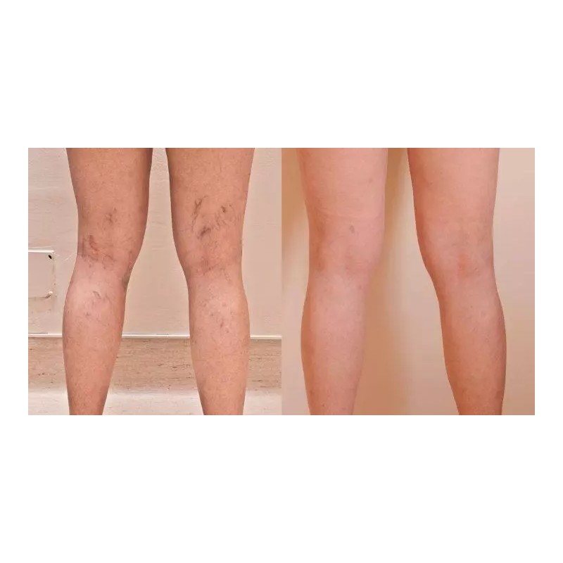 Vitamin K Cream - Eliminate Spider Varicose Veins Rosacea Capillaries