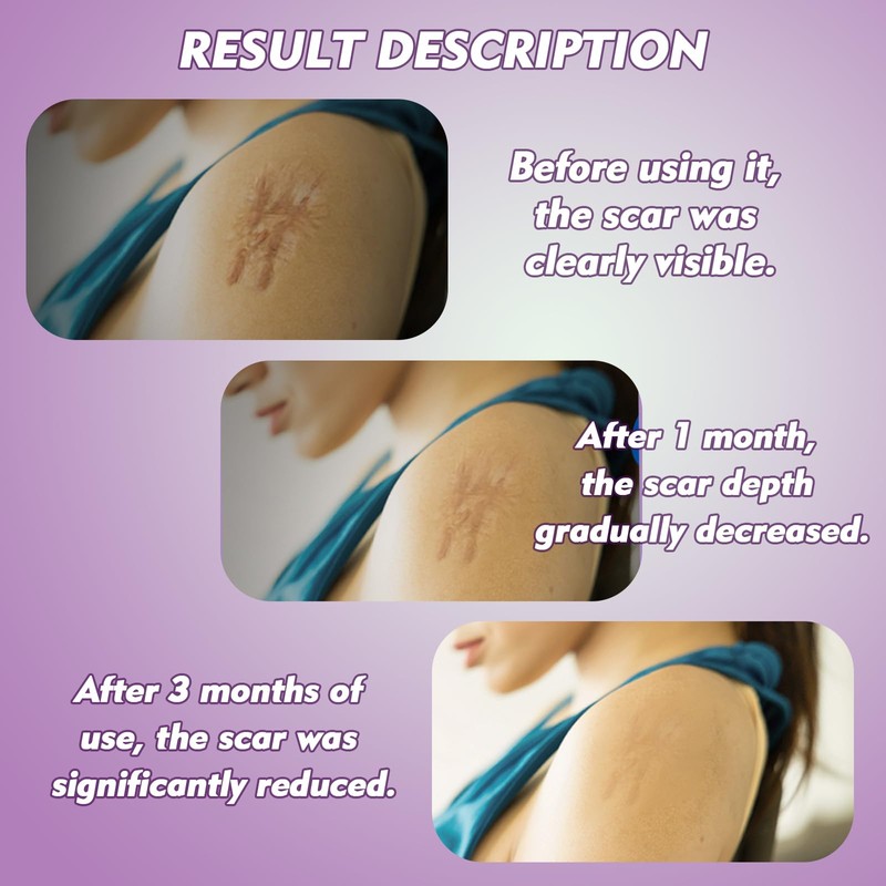 Rayyl Silicone Scar Sheets (1.6" x 60" Roll - 1.5M)