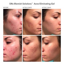 Dr Dennis Gross DRx Blemish Solutions Gel para eliminar el acné: para brotes frecuentes, congestión, textura de baches y piel grasa, 1 fl oz | 30 ml