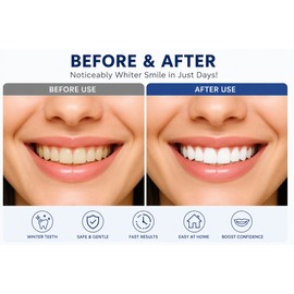 Blue Light Teeth Whitening Device for Home Use – Professional LED Whitening for Brighter, Stain-Free Smiles
