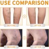 Crema para Venas Varicosas y Araas Vasculares, con Vitamina K,