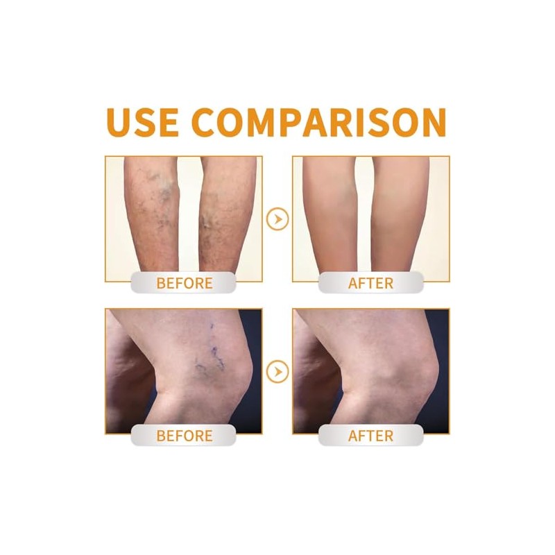 Crema para Venas Varicosas y Araas Vasculares, con Vitamina K,