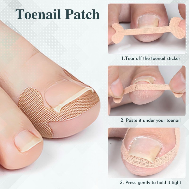 Yuerme Ingrown Toenail Treatment, 81PCS Ingrown Toenail Kit for Toenail