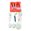 Dental Implant Educational Model, 4X Size, Demonstration Crown and Bridge