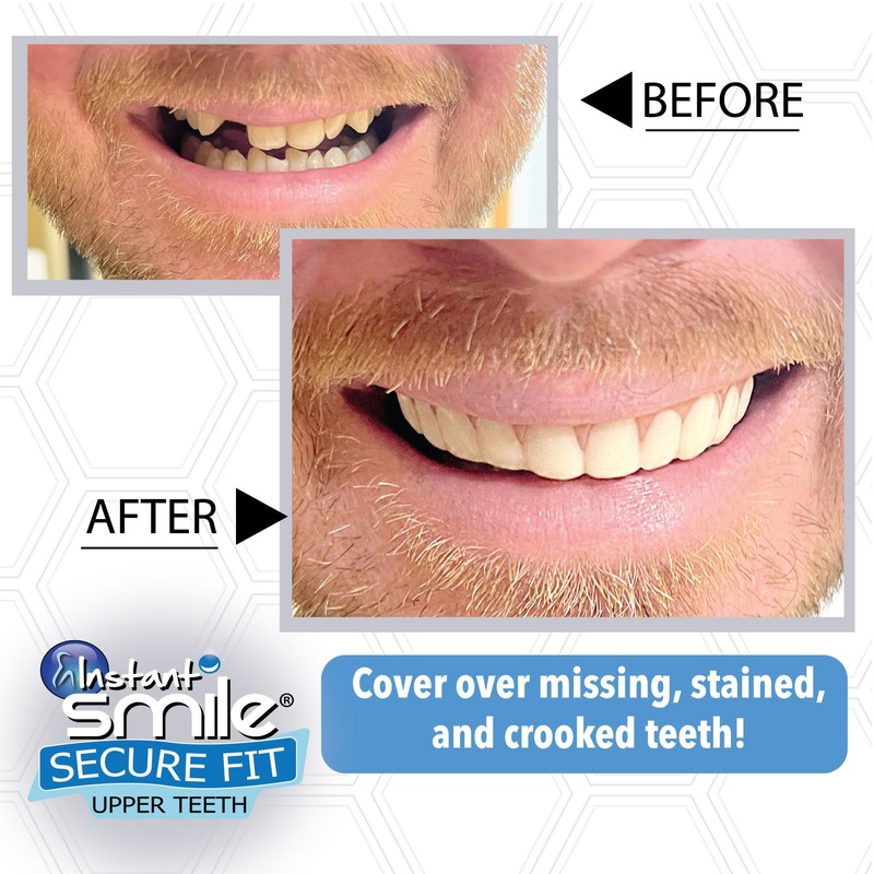Instant Smile Secure Fit Upper Teeth Veneer -
