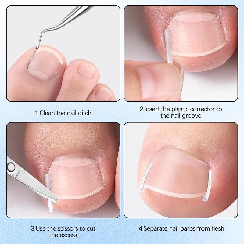Professional Ingrown Toenail Set with Breathable Ingrown Toenail Strips, Curved