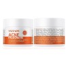 Crema De Tratamiento Del Acné For Espinillas, Puntos Blanc I