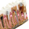 Dental Caries Tooth Anatomy Model Tooth Pathology Models Caries Evolution