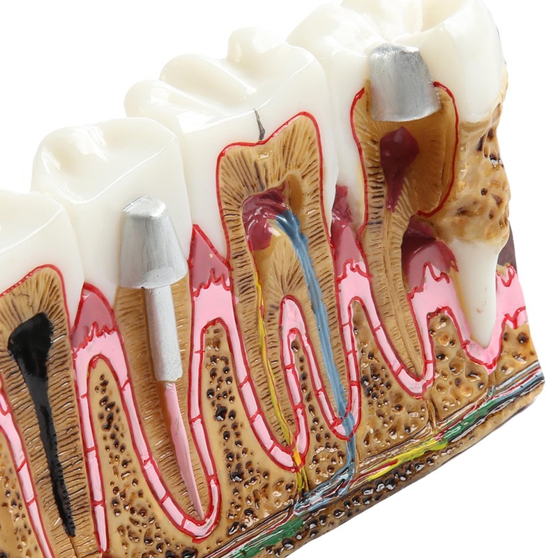 Dental Caries Tooth Anatomy Model Tooth Pathology Models Caries Evolution
