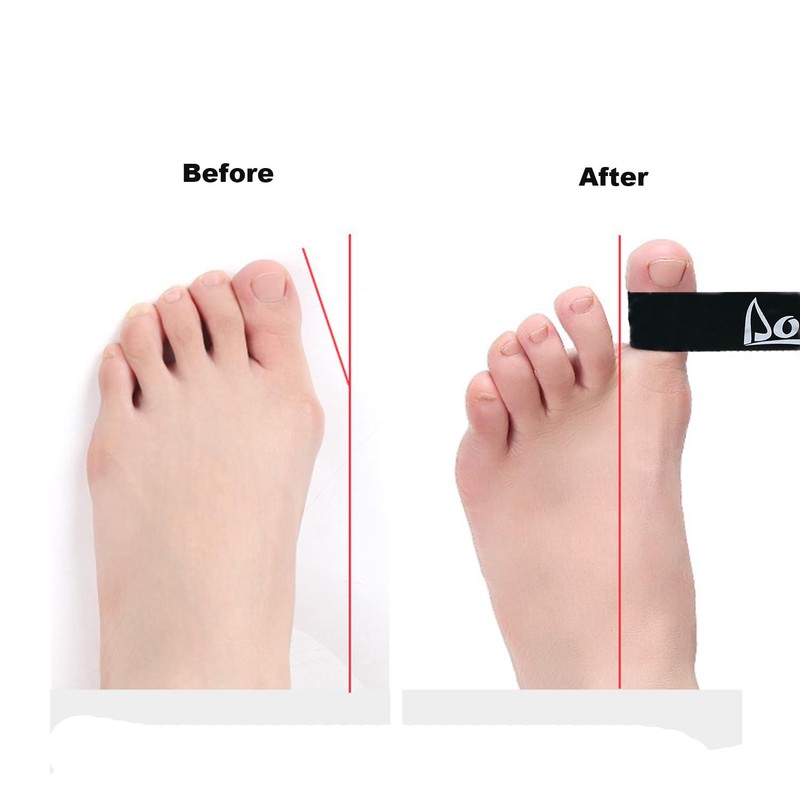 Toe Stretcher Bands - 5 Packs Toe Spacers for Bunion