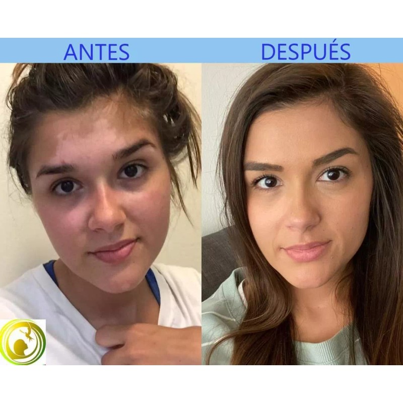 Cenit Jabón Artesanal Pollux 5/pack, Para Piel Con Vitíligo