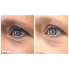 Vitamin K Cream - Eliminate Spider Varicose Veins Rosacea Capillaries