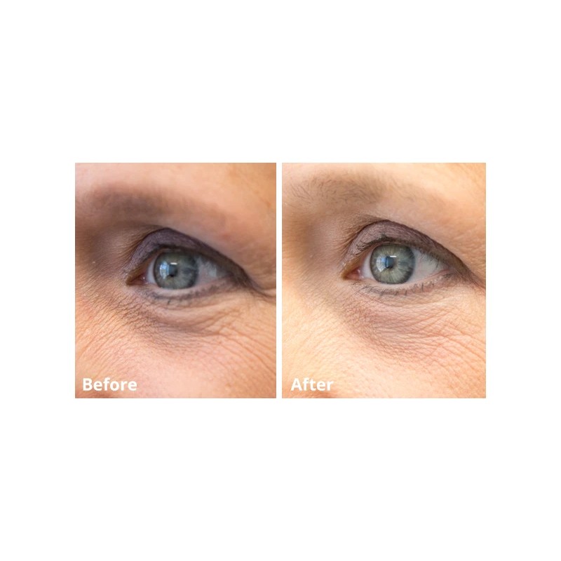 Vitamin K Cream - Eliminate Spider Varicose Veins Rosacea Capillaries