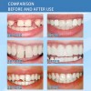 Kit Dientes Postizos Gránulos Moldeables Reparación Dental 30ml