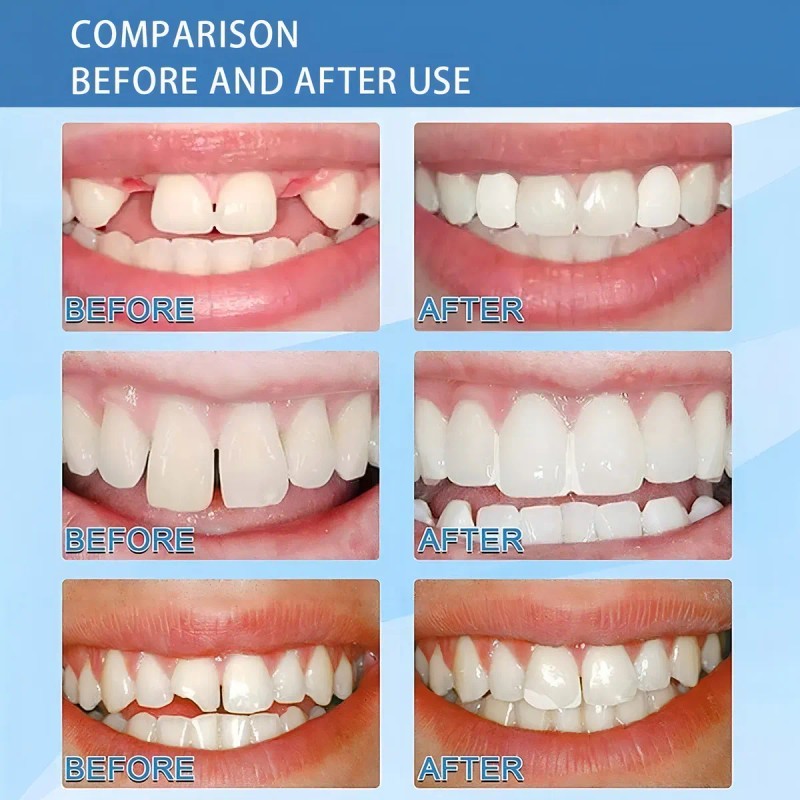 Kit Dientes Postizos Gránulos Moldeables Reparación Dental 30ml