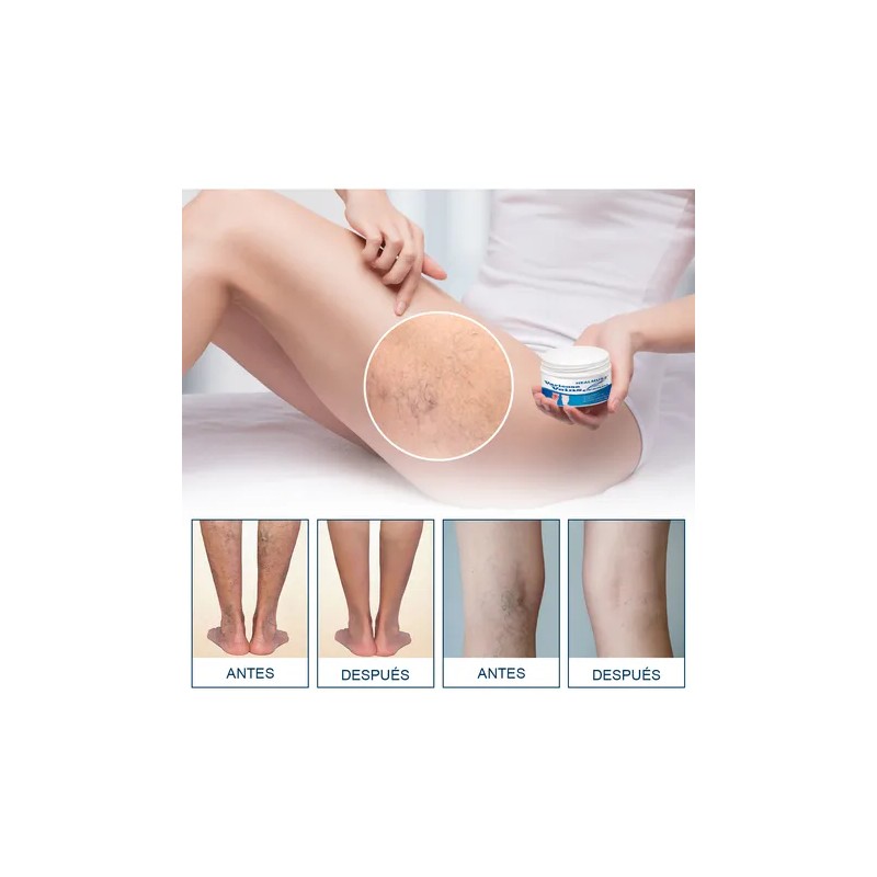 Crema De Venas Varicosas Reducir Las Venas Varicosas 20g