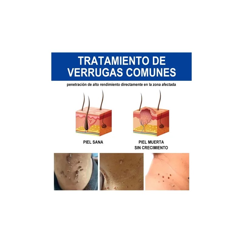 Sistema Verruga Elimina Plantar Comunes 30ml Neutra