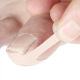 Zanchara Ingrown Toenail Treatment, 20Pcs Breathable Ingrown Toenail Strips,Painless Ingrown Toenail Tool for Nail Removal & Care, At-Home Pedicure Solution (Shape B)