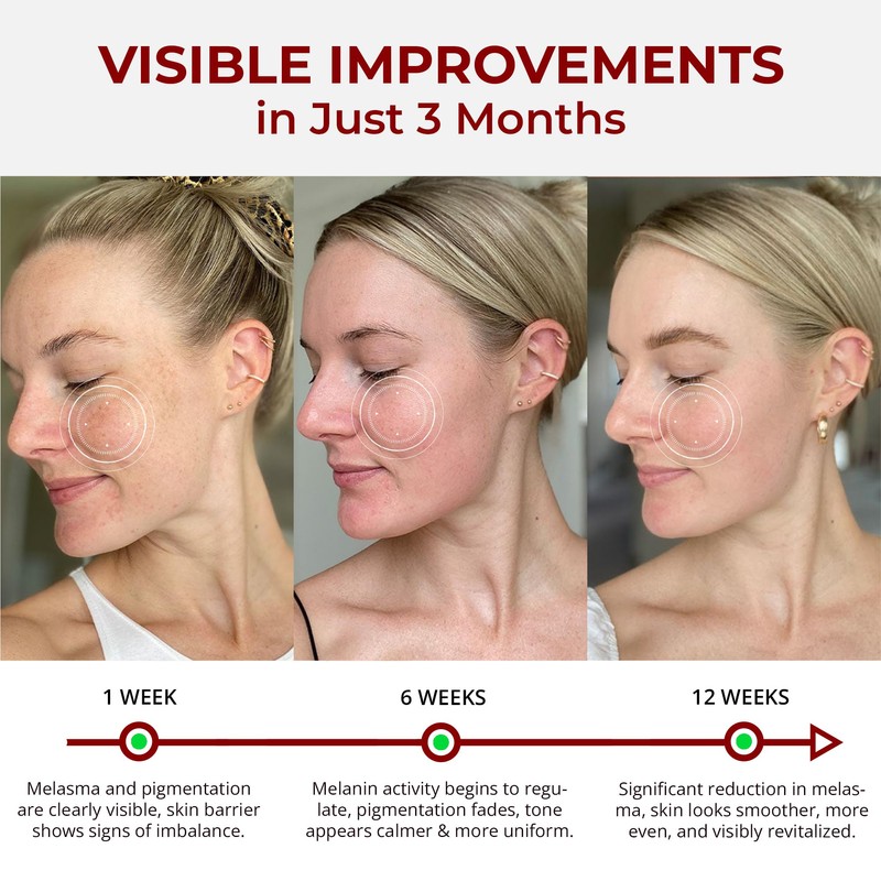 Abera Skin Renewing Serum, Melasma Treatment For Face, High-Performance Anti-Wrinkle,