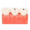 Tankredrug 4 Times Caries Evolution Model Detachable Teeth Disease Teach