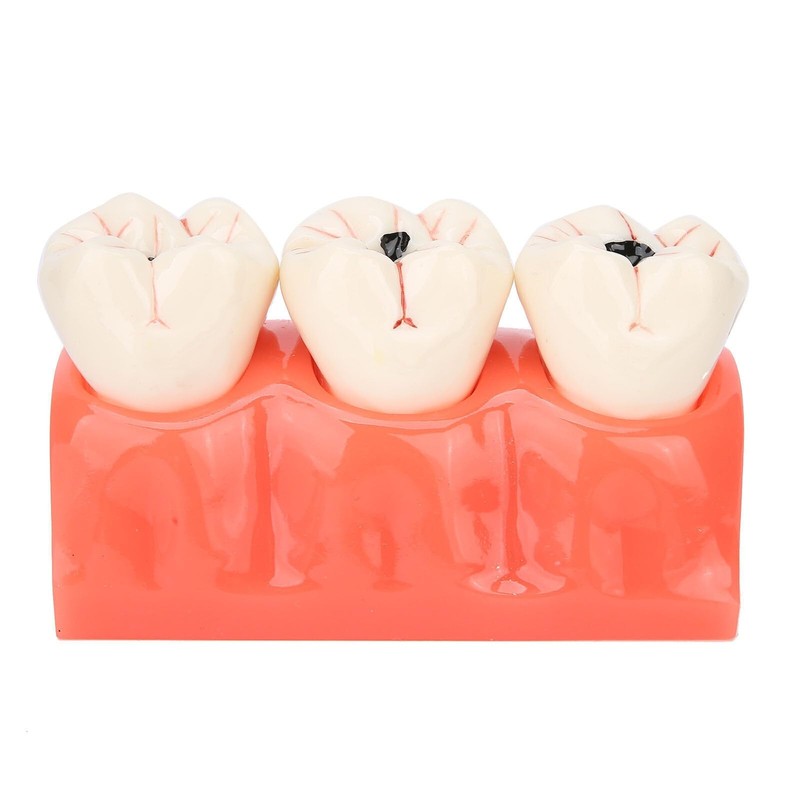 Tankredrug 4 Times Caries Evolution Model Detachable Teeth Disease Teach