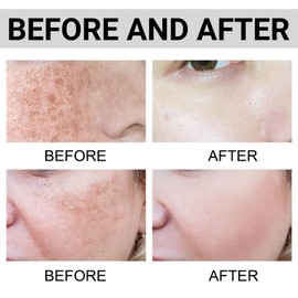 Dark Spot Corrector,Dark Spot Correcting Glow Serum,Da/rk Spot Remover for Face,Brown S/pot Remover Face,Age Spo/t Cream to Reduce Redness and Freckle,Brightening and Moisturizing Acne Serum for All