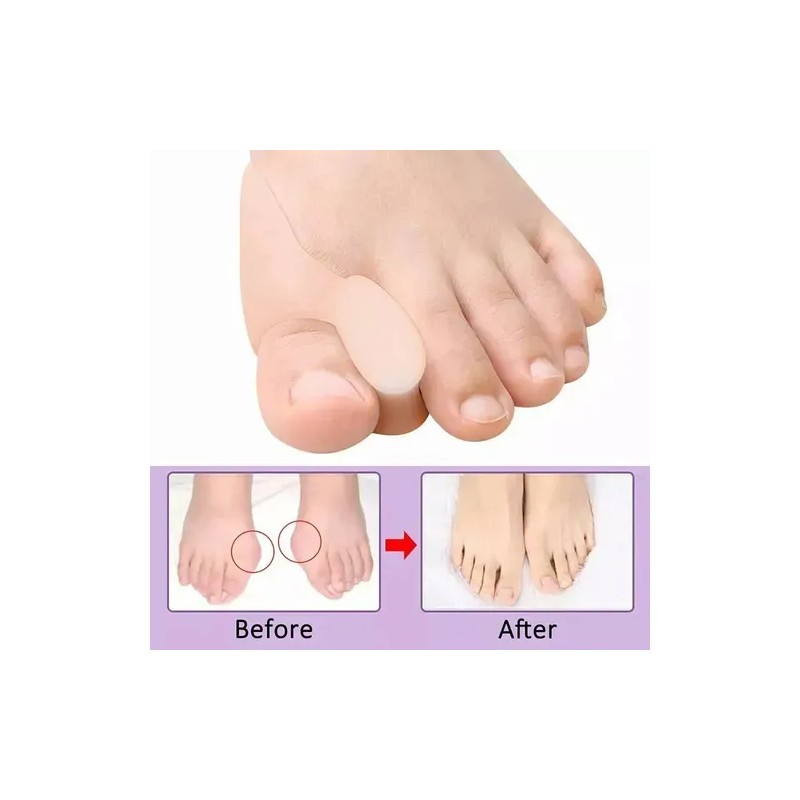 Kit De Correctores De Juanete Y Protectores 11 Pzas Blanco