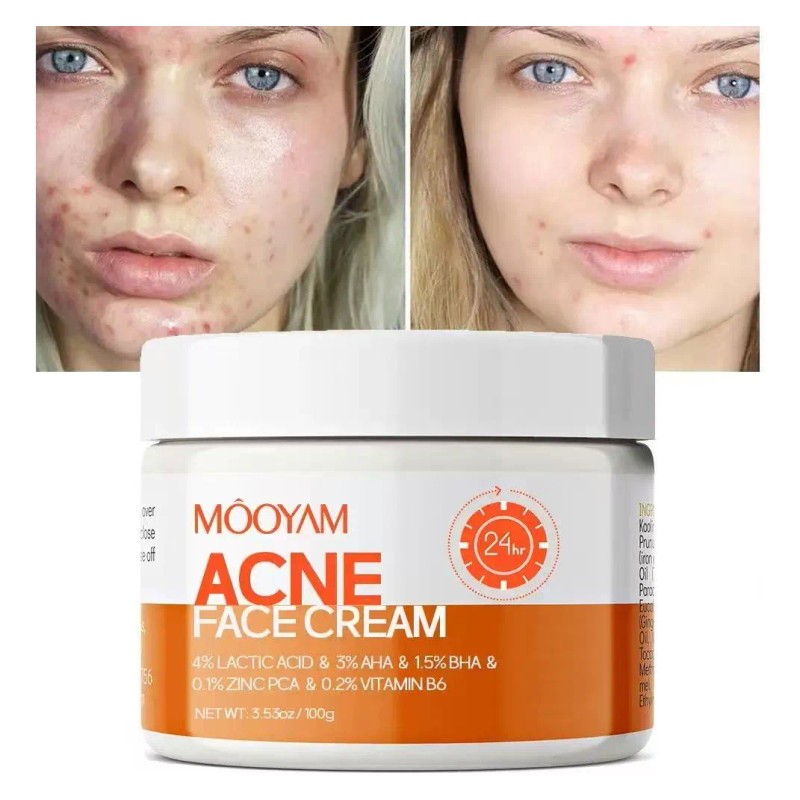 Crema De Tratamiento Del Acné For Espinillas, Puntos Blanc I