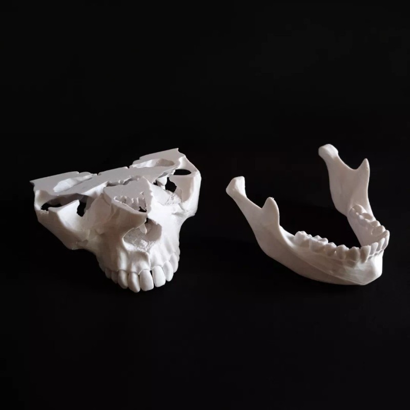 MiniMex 3D Modelo Anatómico Mandíbula 1:1 Y Mini-implante Impresos 3d