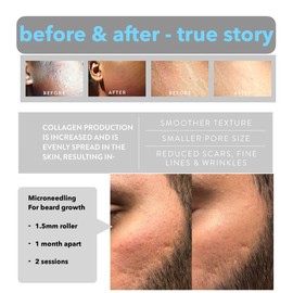 Derma Roller Kit For Hair and Beard Growth 540 Micro REAL SILVER Needles 0.3mm Anti Ageing Wrinkles Scar Stretch Marks Hair Loss Suitable for man & Women Factory Direct