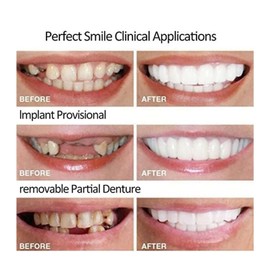 2 Pairs, Temporary Nature and Comfortable, Adjustable for Men and Women, Top and Bottom (1)