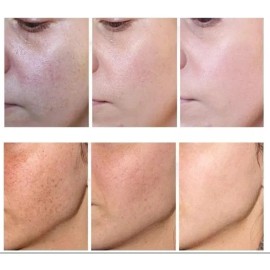 Crema despigmentante elimina melanina, melasma y pecas, uso día y noche