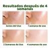 Liquido Antiacne Serum Reparador Espinillas Acido Salicilico