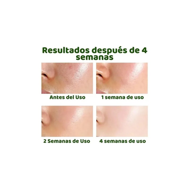 Liquido Antiacne Serum Reparador Espinillas Acido Salicilico