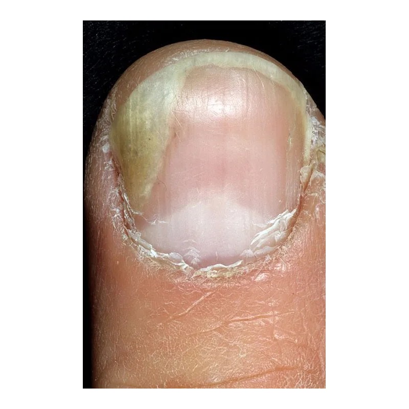 Vité 20 Crema Antihongos (12 Piezas)