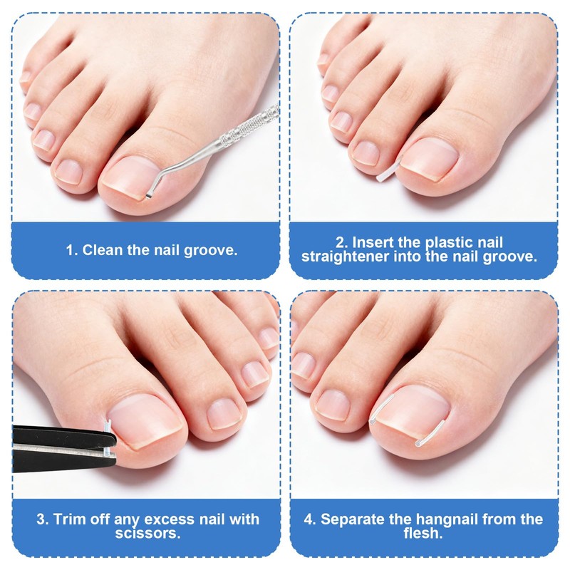 17pcs Ingrown Toenail Corrector Set, Professional Ingrown Toenail Pedicure Tools