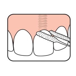 Tepe Bridge & Implant Floss 30 pcs