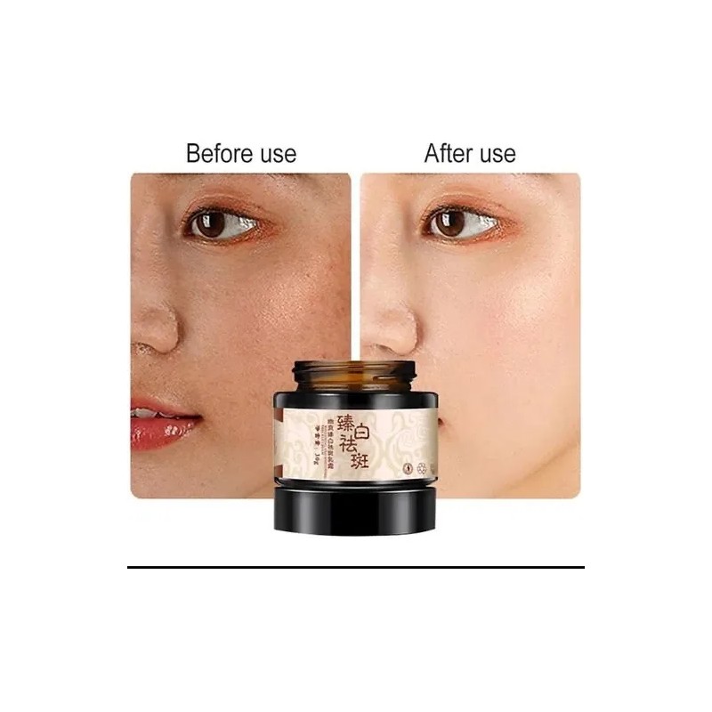 Crema Despigmentante De Manchas Paño Melasma Pecas Blanquea